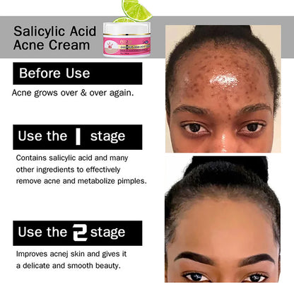Acne Removal Face Cream For Clear Skin