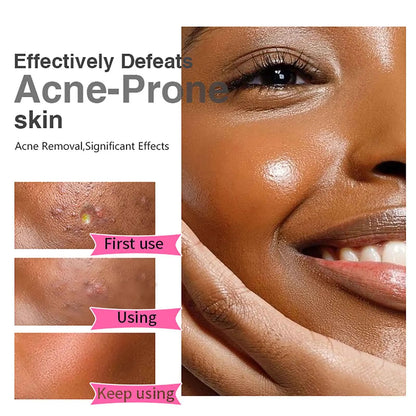 Acne Removal Face Cream For Clear Skin