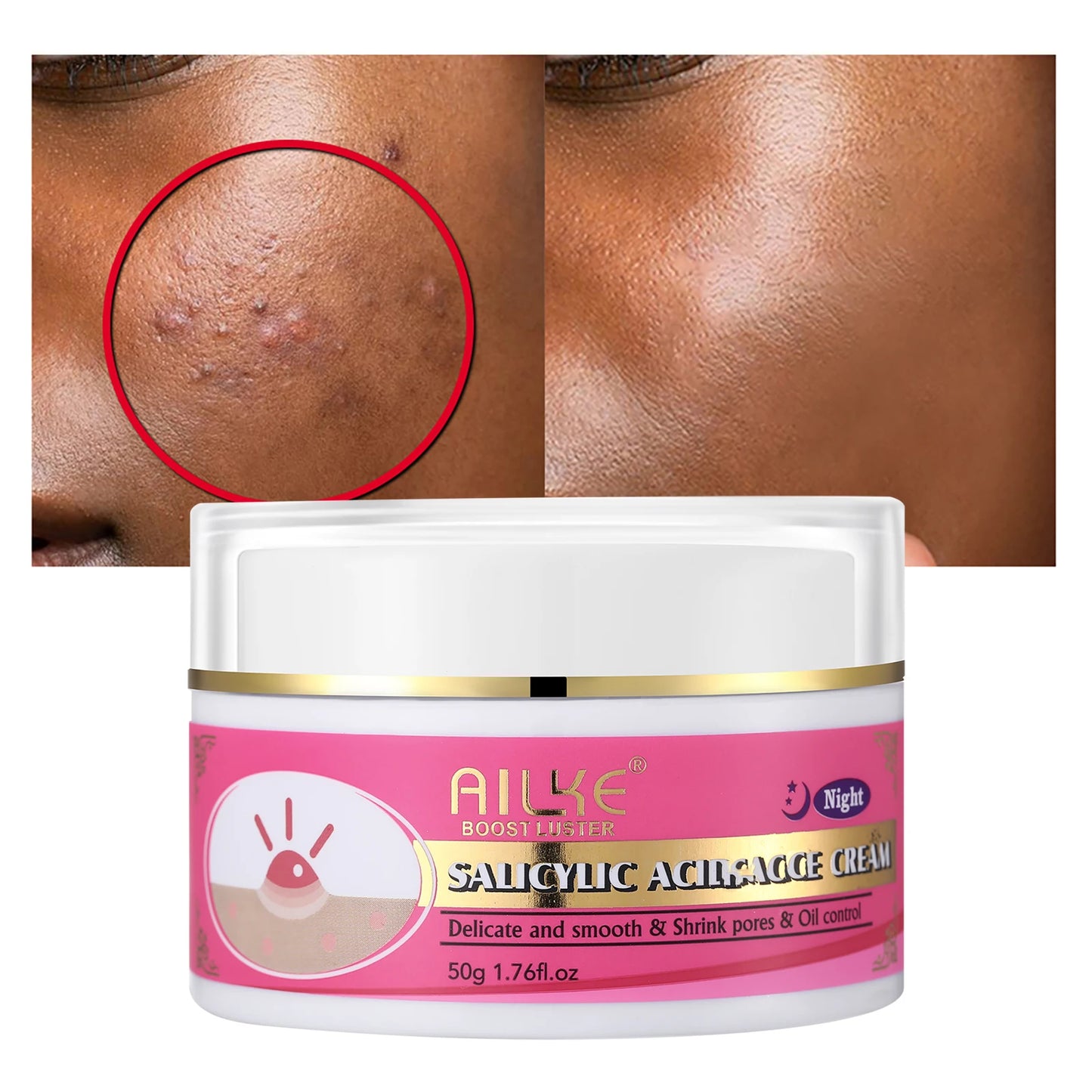 Acne Removal Face Cream For Clear Skin