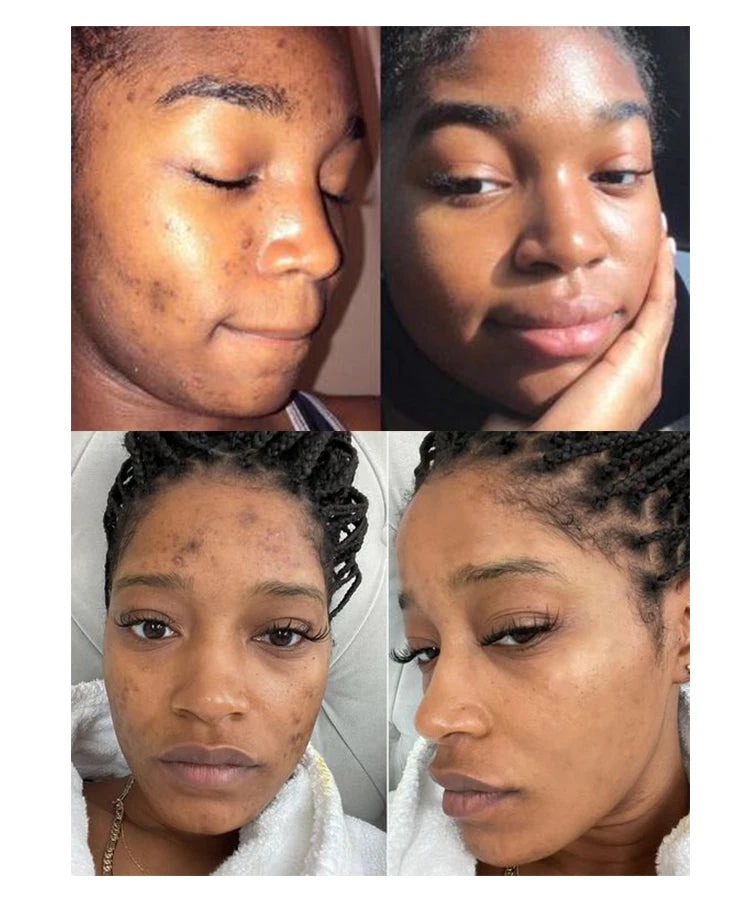 Acne Removal Face Cream For Clear Skin