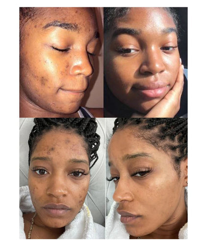 Acne Removal Face Cream For Clear Skin